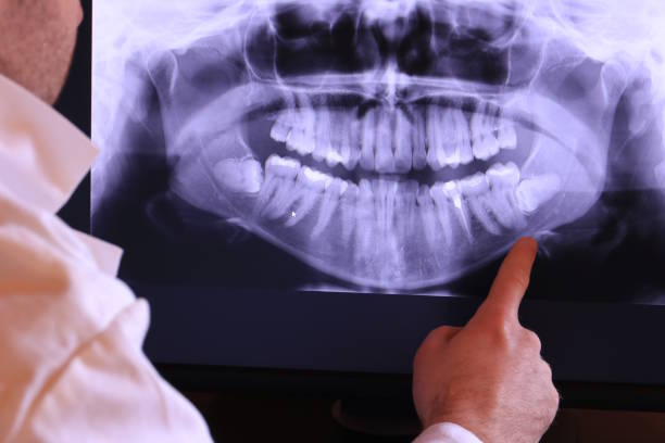 Best Emergency Tooth Extraction in Stanford, CA