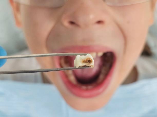 Best Emergency Treatment for Toothache in Stanford, CA
