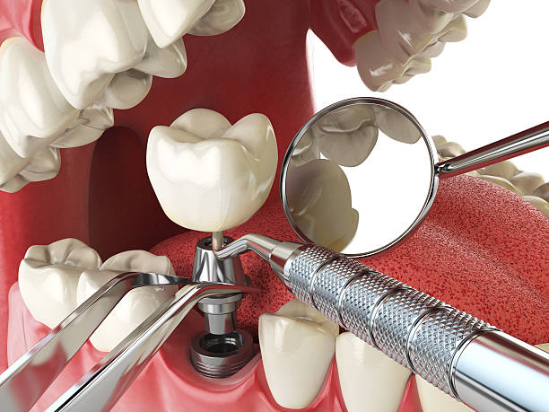 Best Emergency Tooth Extraction in Stanford, CA
